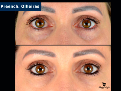 Harmonização facial cruz alta