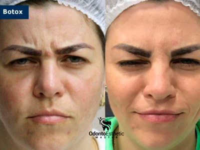 Harmonização facial cruz alta