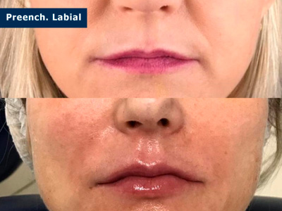 Harmonização facial cruz alta