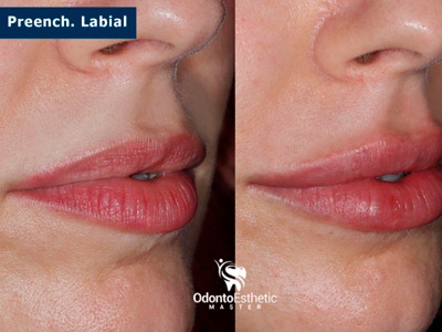 Harmonização facial cruz alta