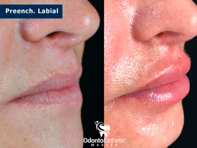 Harmonização facial cruz alta