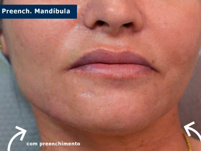 Harmonização facial cruz alta