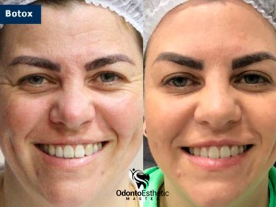 Harmonização facial cruz alta