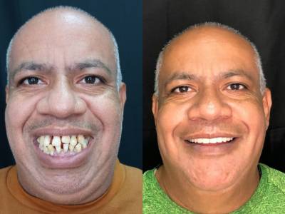 antes e depois PRÓTESE PROTOCOLO cruz alta dentista