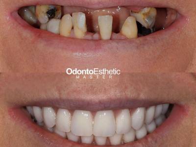 antes e depois PRÓTESE PROTOCOLO cruz alta dentista