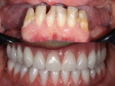 antes e depois PRÓTESE PROTOCOLO cruz alta dentista
